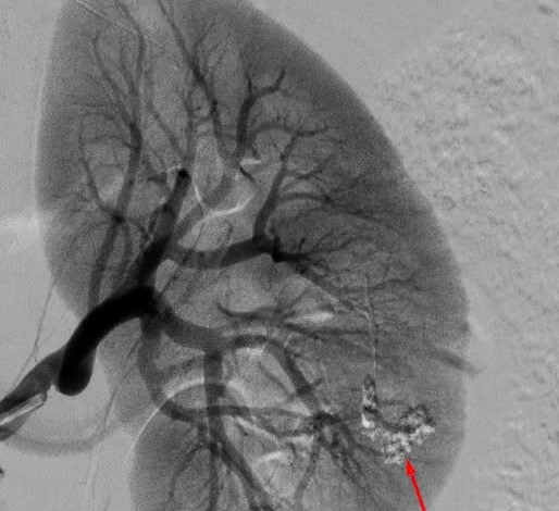 Timely emergency care and 17-week fetal preservation when the mother had a renal tumor. Photo: BVCC