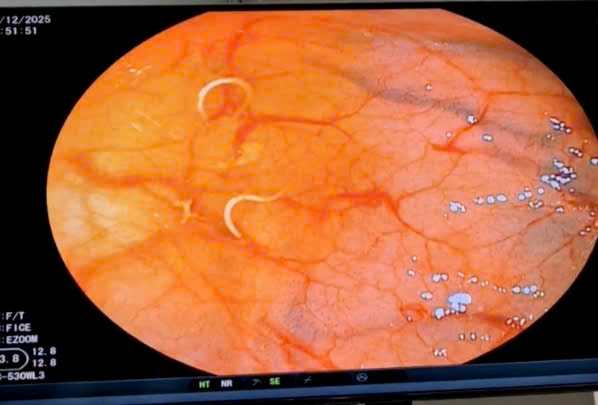 만성 소화 장애 내시경 검사에서 대장 내 편충 서식지 발견. 사진: Thanh Dang