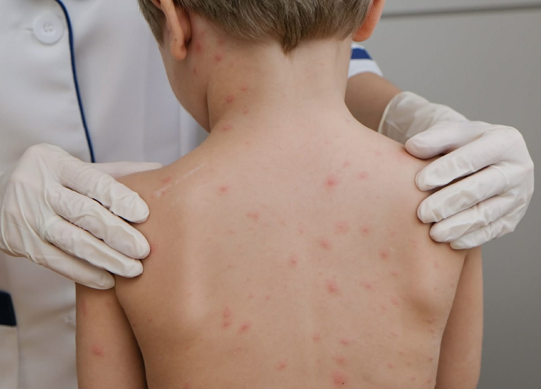 90% so benh nhan bi nhiem thuy dau la tre em trong khoang tu 2 den 7 tuoi Anh: Naviva Group