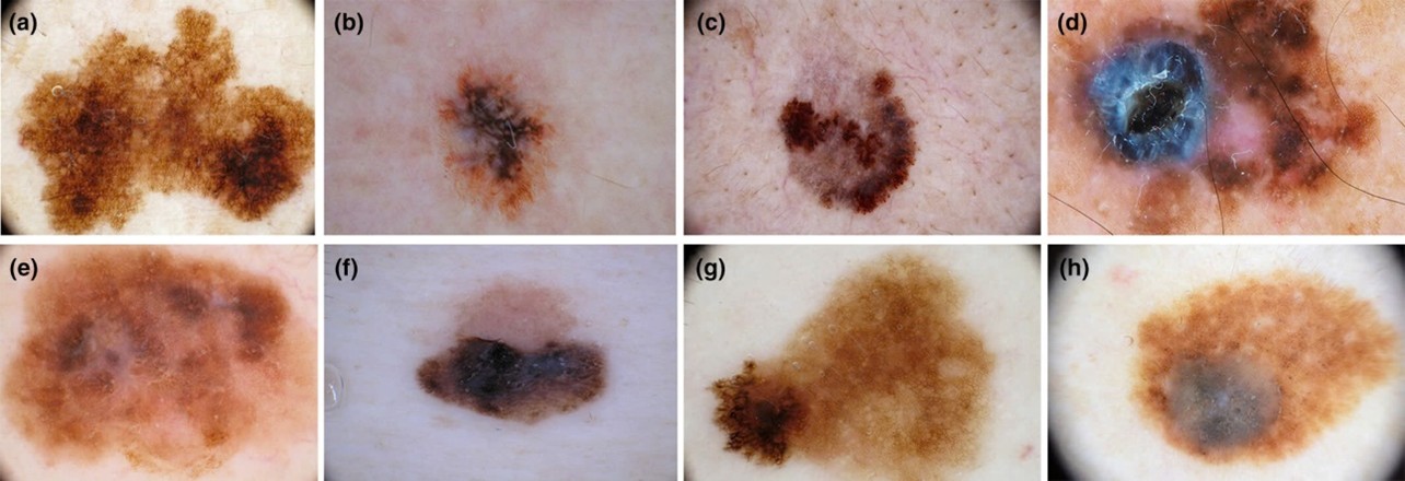 Hinh anh Melanoma tren Dermoscopy: khong dong deu sac to, bo khong ro. Anh: Bs. Nguyen Huu Quang, BV Da lieu Trung uong