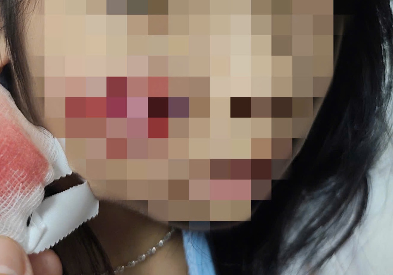 The girl was injured when attacked by a monkey. Photo: Quang Binh Friendship Hospital