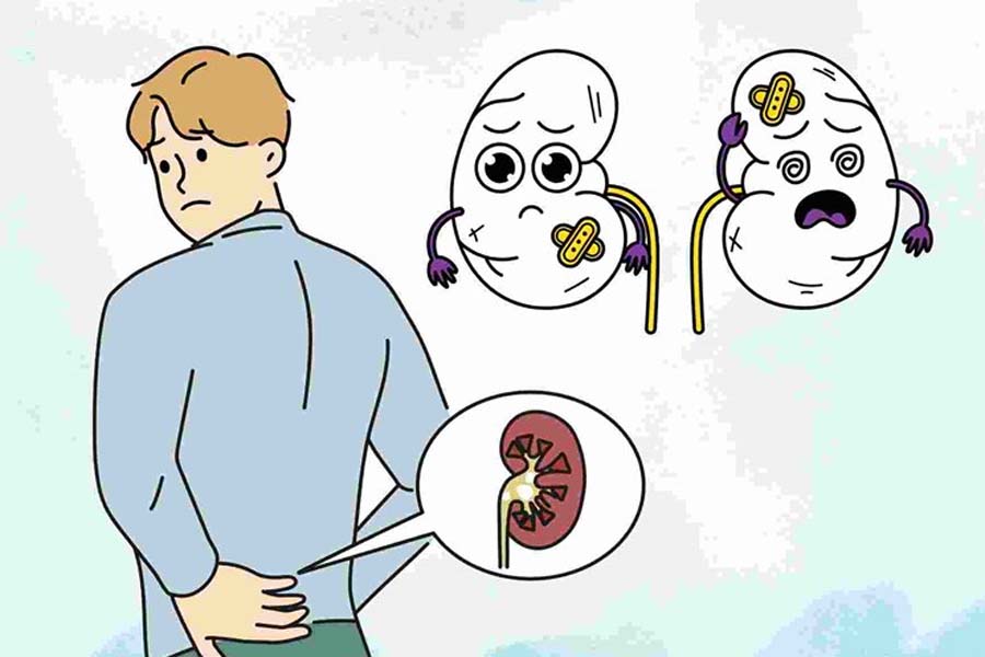 kidney specialists warn that the habit of drinking less water in the cold season can silently cause kidney stones and share five ways to protect the kidneys. Graphics: Dinh Dinh