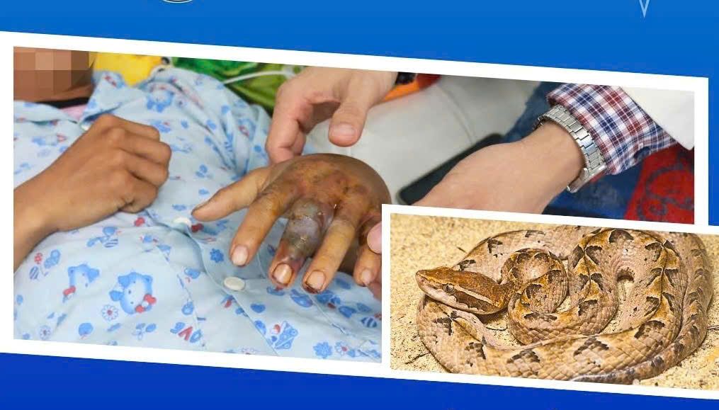 The hand of a young man in Khanh Hoa was bitten by a snake and tu nhien treated with leaves. Photo: Ninh Thuan General Hospital