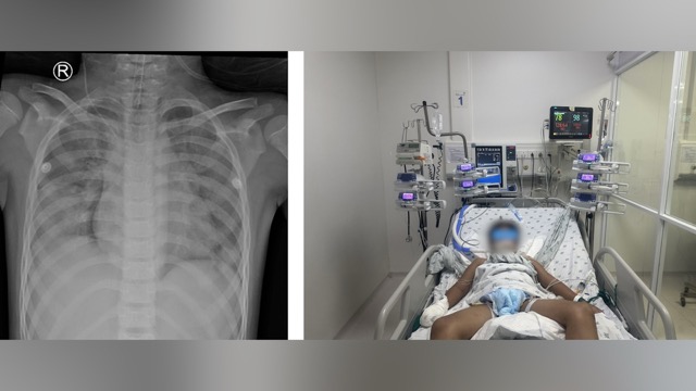 The patient was treated by doctors and successfully saved. Photo: BVCC