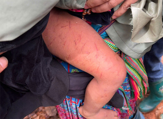 Chau be duoc tim thay voi nhieu vet xuoc tren co the. Anh: Cong an Lai Chau