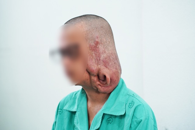 The patient's tumor before being operated on by doctors. Photo: BVCC