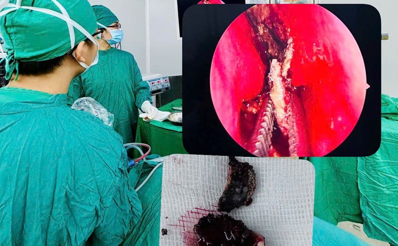 Taking foreign object that has existed for many years in the patient's nose