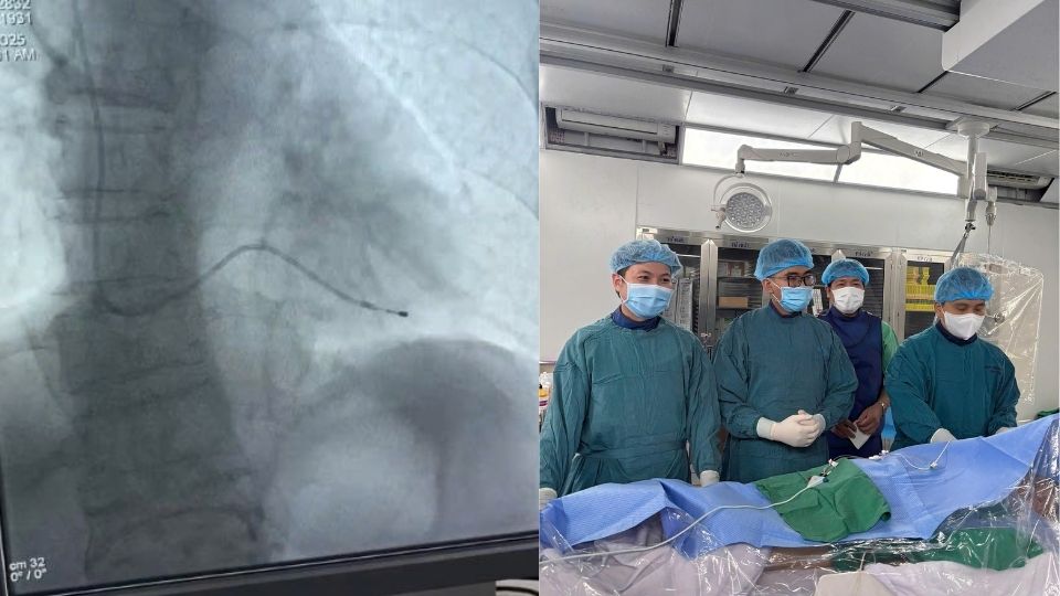 The team of doctors from the Department of Cardiology - Geriatrics, Vinh Long General Hospital performed the technique of placing a temporary rhythm machine to provide emergency care for a 94-year-old patient. Photo: Vinh Long General Hospital