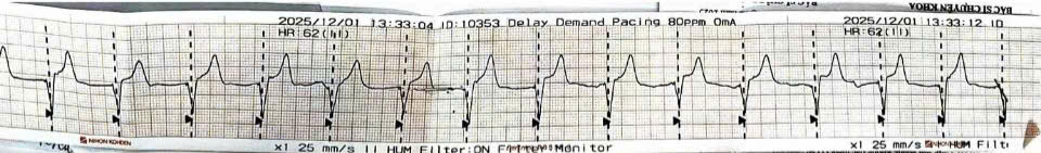 Sau dat may do lai dien tim benh nhan ghi nhan nhip may tan so 62 lan/phut. Anh: BVDK Vinh Long