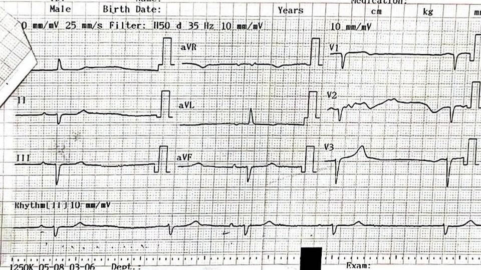 Dien tim benh nhan truoc khi dat may tao nhip tam thoi ghi nhan nhip xoang xen ke nhip bo noi tan so 36 lan/phut. Anh: BVDK Vinh Long 