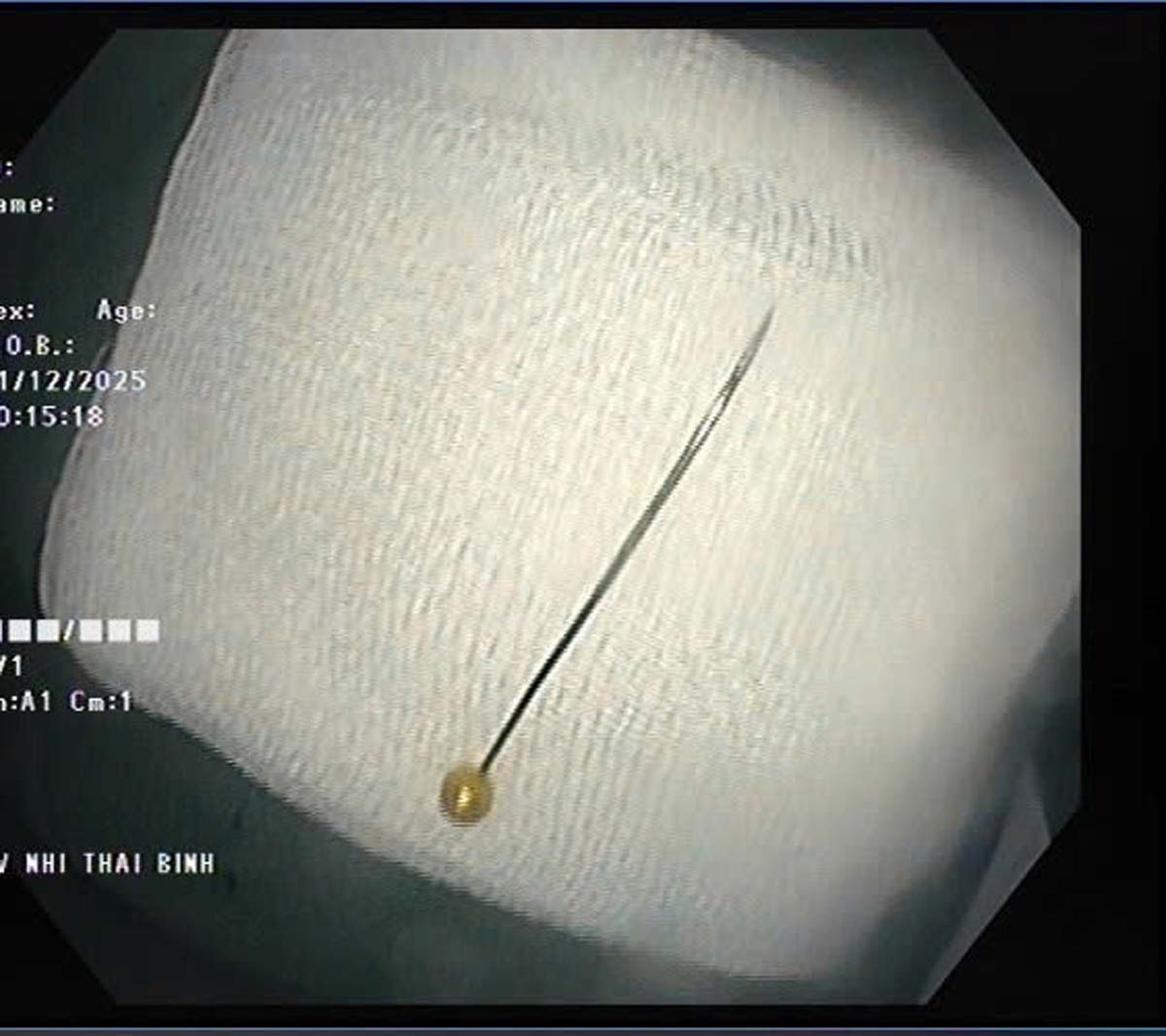 A tailor in the duodenum of an 11-month-old baby. Photo: Thai Binh Children's Hospital, Hung Yen Province