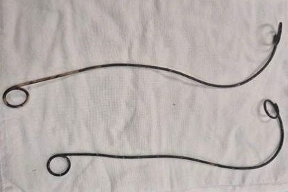 The two JJ wires in a patient in Ca Mau have only been removed by surgery for more than 10 years. Photo: Nhat Ho