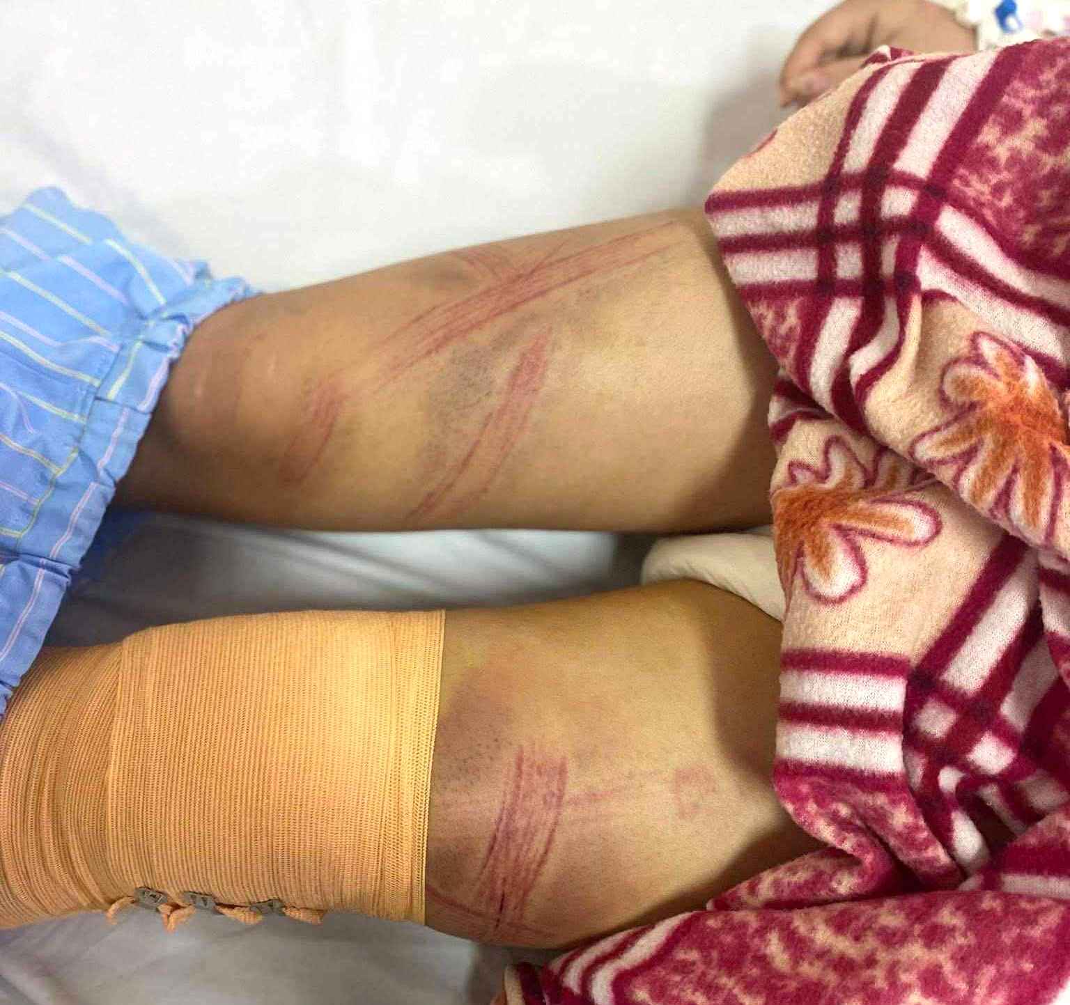 A 7th grade female student in Tay Hieu ward (Nghe An) was hospitalized with many bruises on her body. Photo: Ngoc Anh