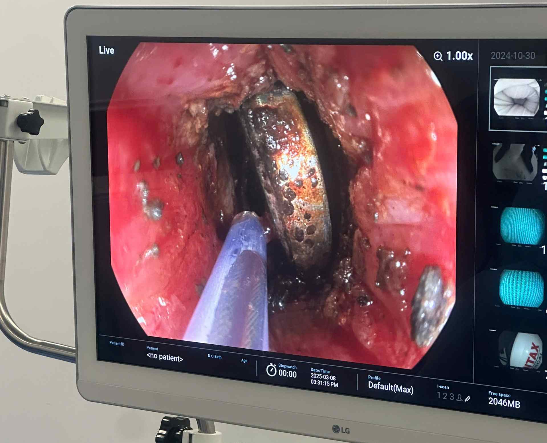 Theo cac bac si, trong so cac ca tai nan thuong tich thuong xuyen gap phai la tre nuot phai di vat. Anh: BVCC