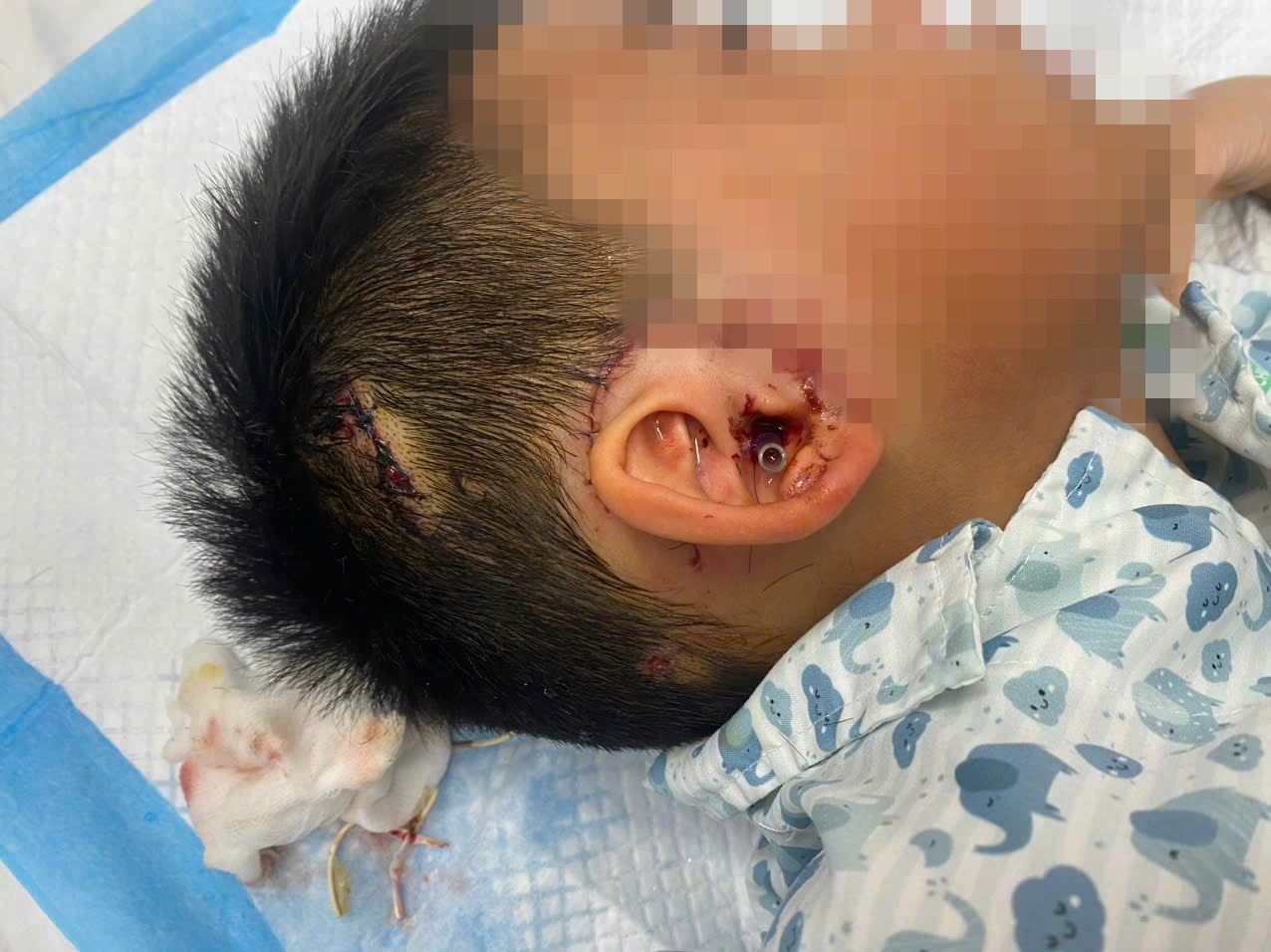 Mot benh nhi phai nhap vien cap cuu vi tai nan thuong tich. Anh: BVCC