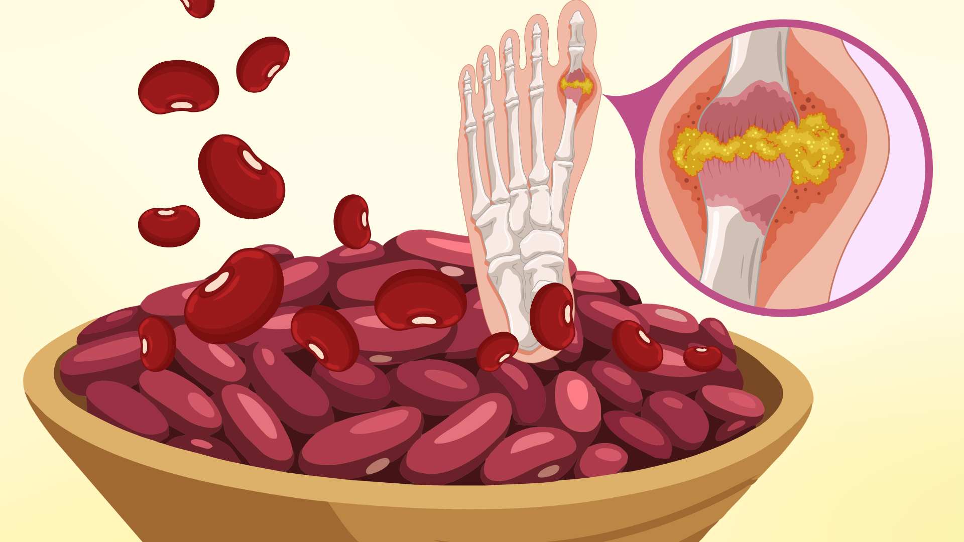 요산 수치를 낮추는 데 도움이 되는 붉은 팥과 결합된 3가지 식품