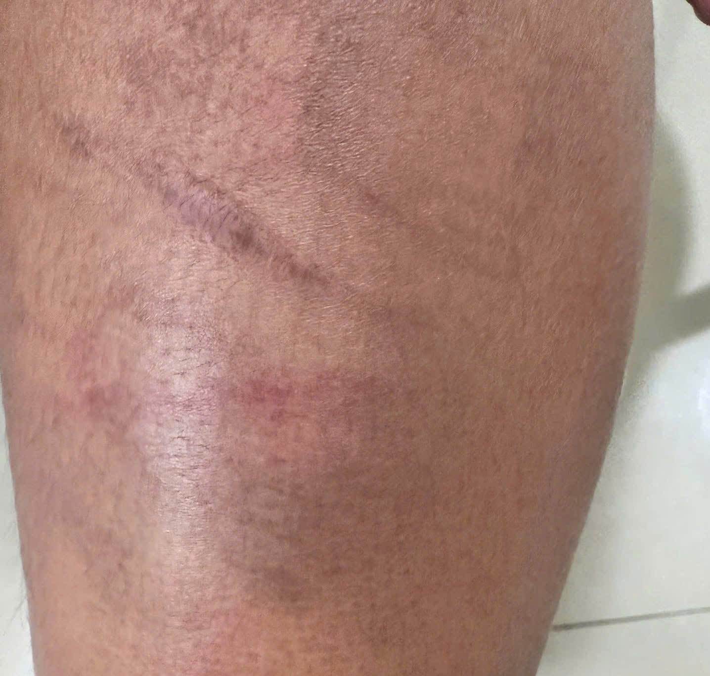 Các vết bầm trên chân của các đứa trẻ do bị người đàn ông hành hung. Ảnh: Gia đình nạn nhân cung cấp