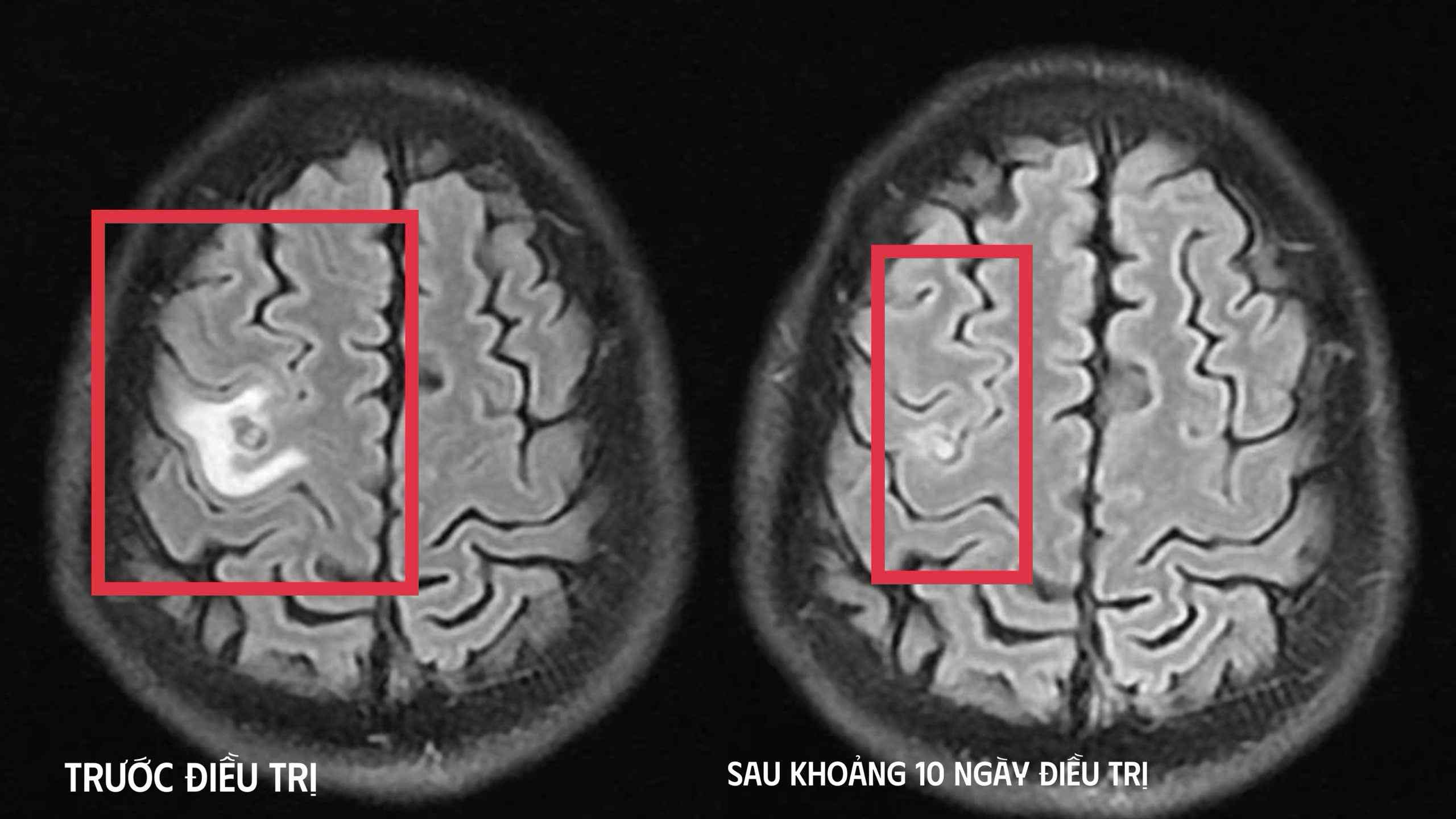 기생충으로 인한 발작 뇌종양 오진될 뻔함. 사진: BVCC