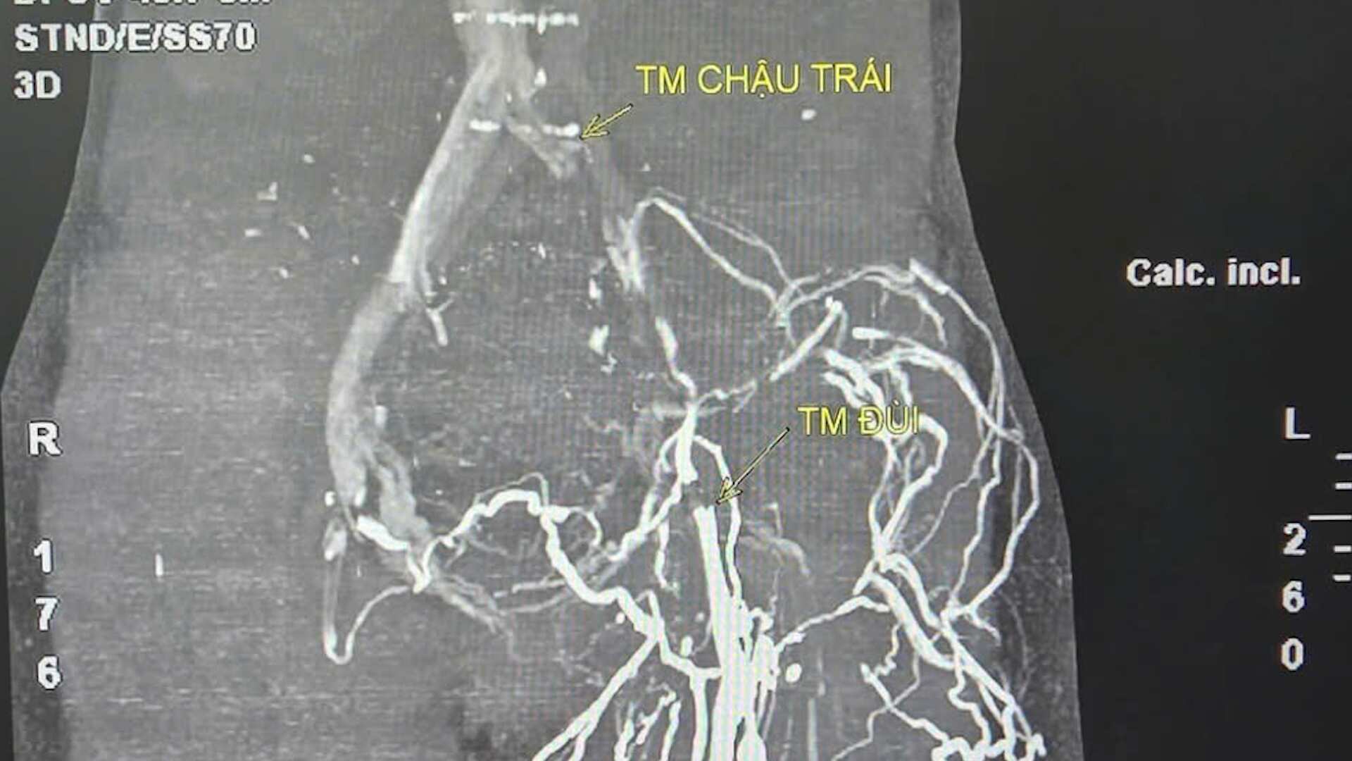 Ket qua chup CT mach mau cho thay benh nhan bi hep tinh mach chau trai, kem theo su hinh thanh nhieu mach mau bang he. Anh: Cao Thom