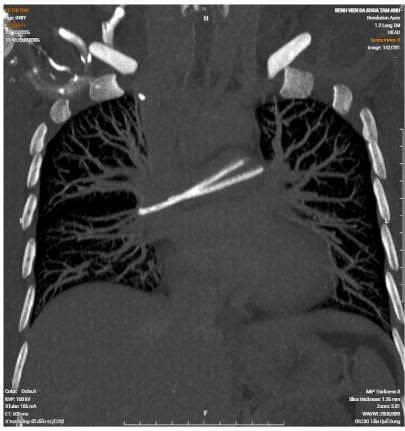 X-ray of a foreign object in a chemical port overpass that broke and floated into the heart. Photo: BVCC