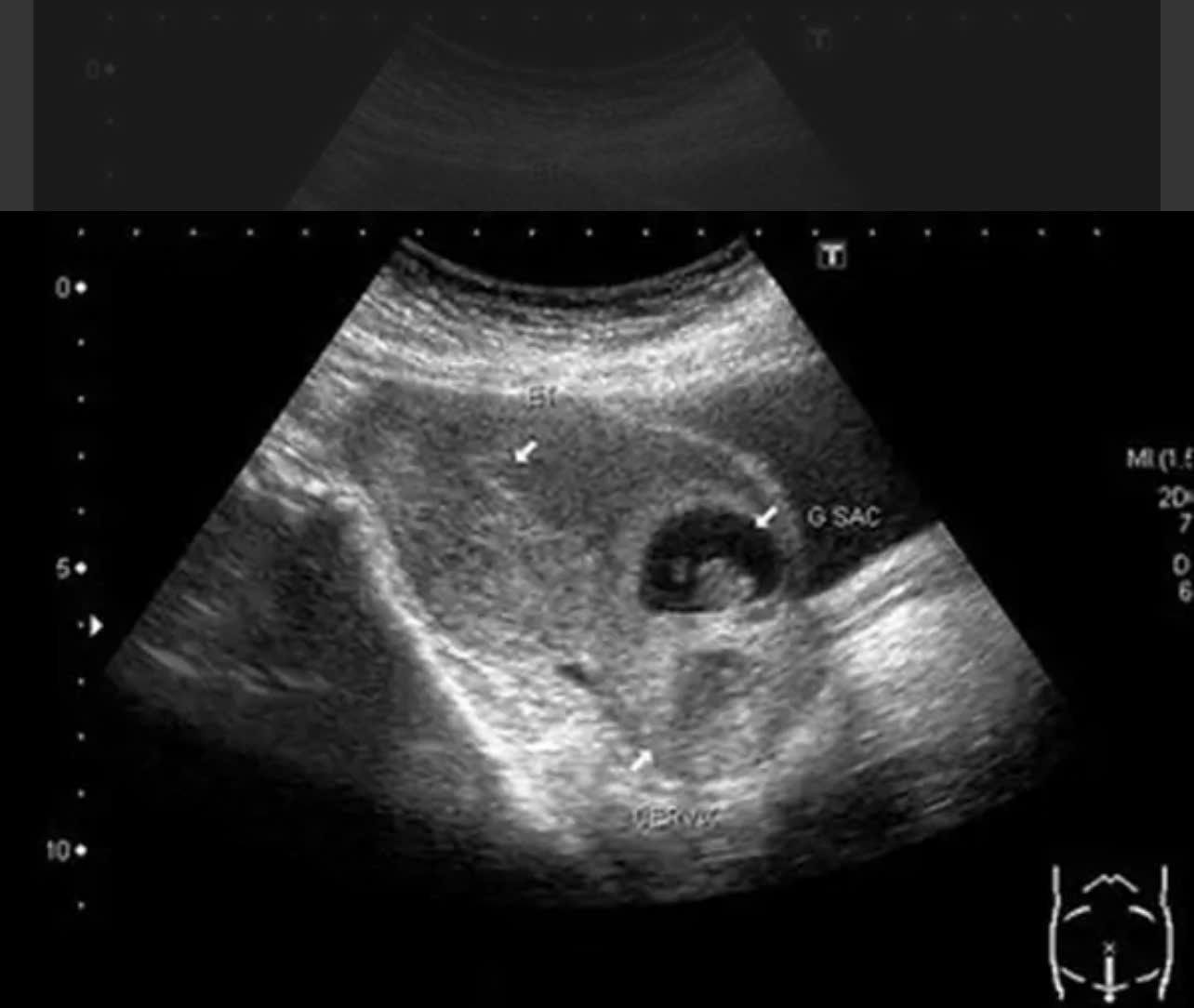 The location of the placenta was on the old incision, causing the mother to be in critical condition when performing an illegal miscarriage at home. Photo: Lang Son General Hospital