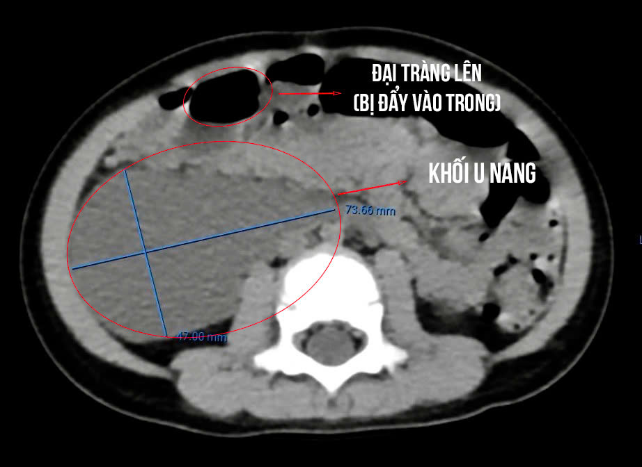 26-month-old baby carrying a rare large cyst. Photo: TTH Quang Binh General Hospital
