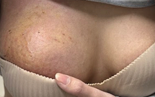 Complicaciones de la inyeccion de relleno mamario. Foto: BSCC