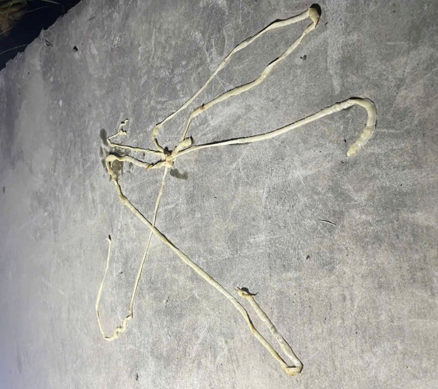 Imagen del tenia de cerdo de casi 10 m de largo del paciente H. Foto: Portal de informacion electronica del Departamento de Salud de Hai Phong