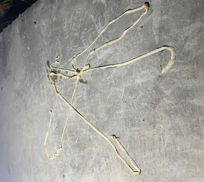 Phát hiện sán lợn dài gần 10m trong cơ thể người đàn ông ở Hải Phòng