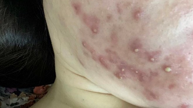 According to dermatologists, some small changes in diet can help balance hormones, reduce inflammation and limit recurrence of acne around the chin. Photo: Nguyen Ly