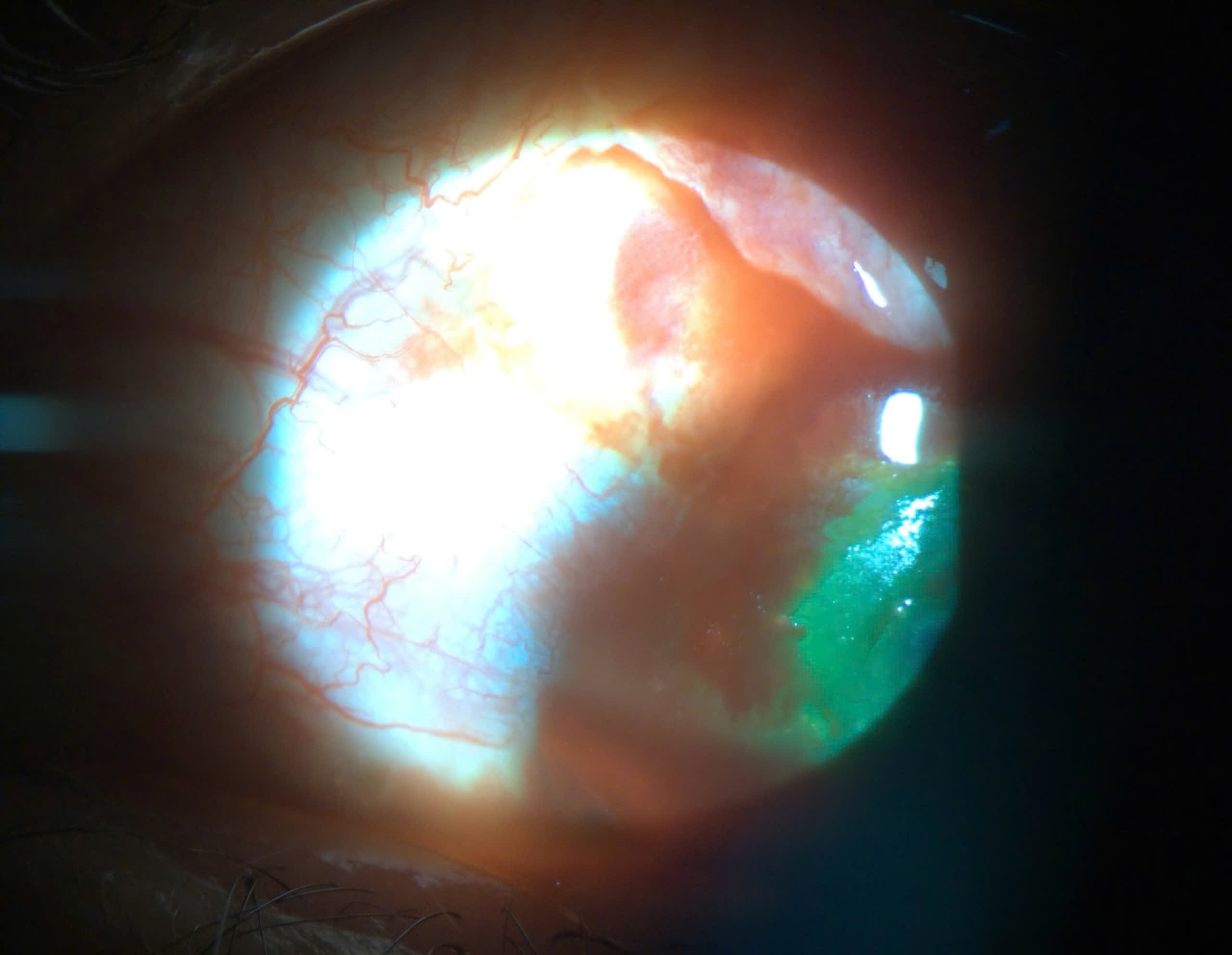 Mot truong hop bi rach giac mac do gap tai nan luc hai ca phe den benh vien dieu tri. Anh: Benh vien Mat Sai Gon Da Lat 