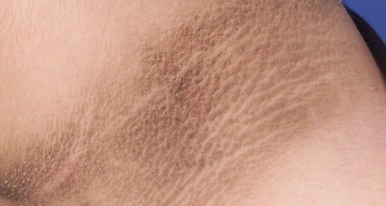 Dark patches on the neck of a young child, an early sign of metabolic disorders. Illustrative photo: Ho Chi Minh City Dermatology Hospital