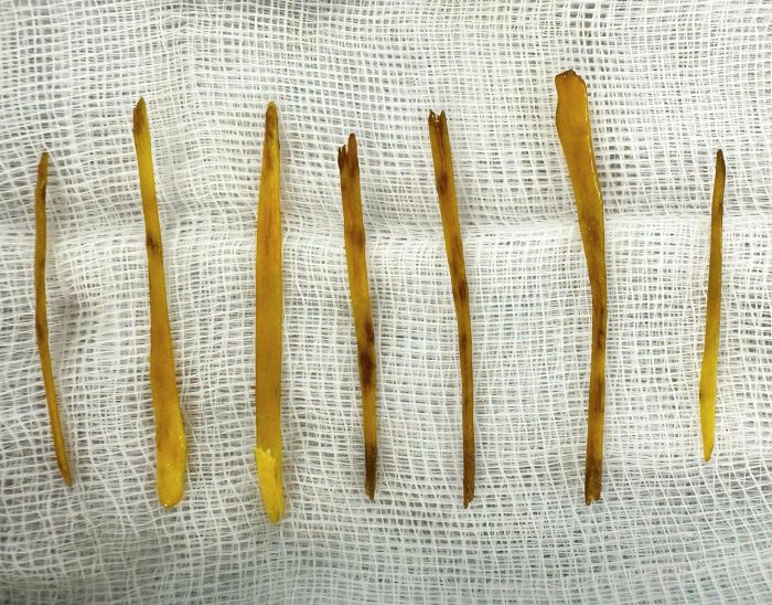 Hinh di vat la cac manh xuong ga duoc bac si lay ra thanh cong. Anh: Benh vien cung cap