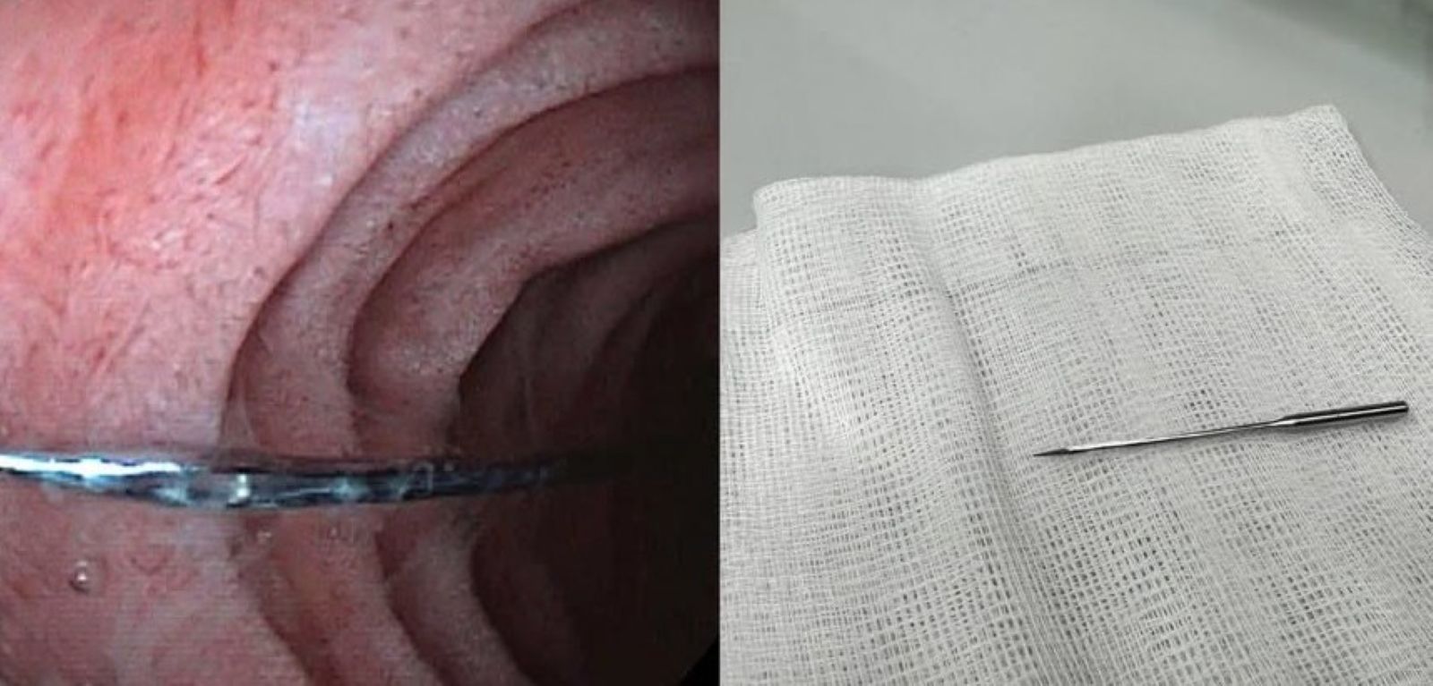 Di vat la kim may bang sat mot dau nhon co chieu dai 4cm duoc lay khoi duong tieu hoa cua benh nhi. Anh: Benh vien cung cap