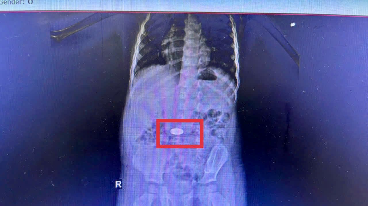 Khanh Hoa ghi nhan 5 tre phai nuot dong xu vao bung