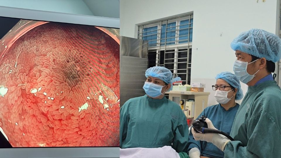 Noi soi tieu hoa dai tan hep (NBI) lam noi bat hinh thai niem mac voi do tuong phan cao, ho tro phat hien nhung thay doi bat thuong kho thay bang noi soi thuong. BVDK Vinh Long