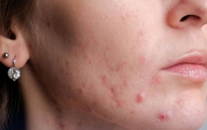 특히 턱, 이마, 양쪽 뺨 주변에서 지속적인 여드름 발진은 지방간 감염을 경고합니다. 사진: Nhu Ha