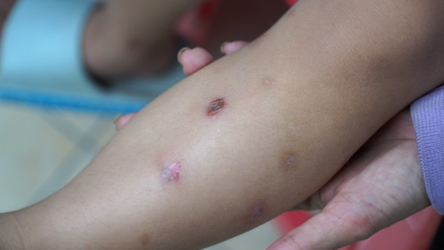 Many children have contracted choc disease in Ho Chi Minh City in recent times. Photo: Nguyen Ly