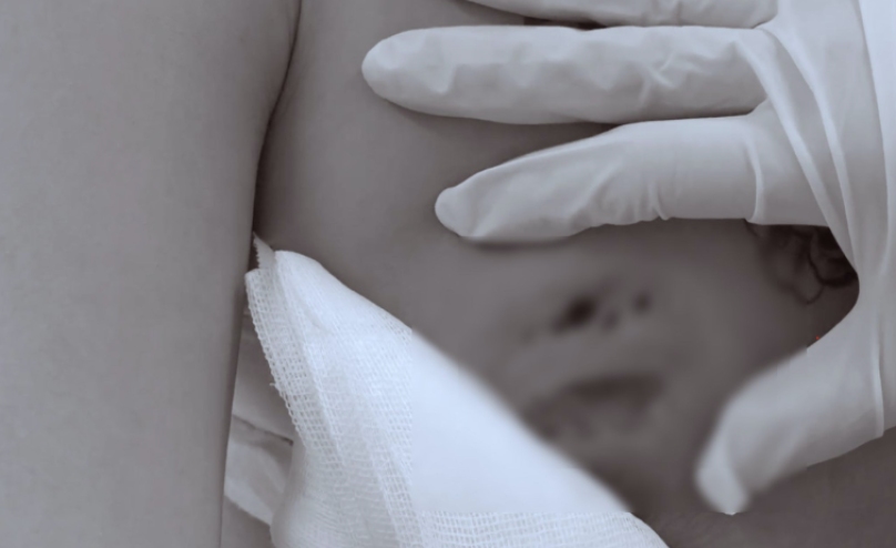 Ruoc hoa vi tiem filler nang nguc. Anh: BVCC