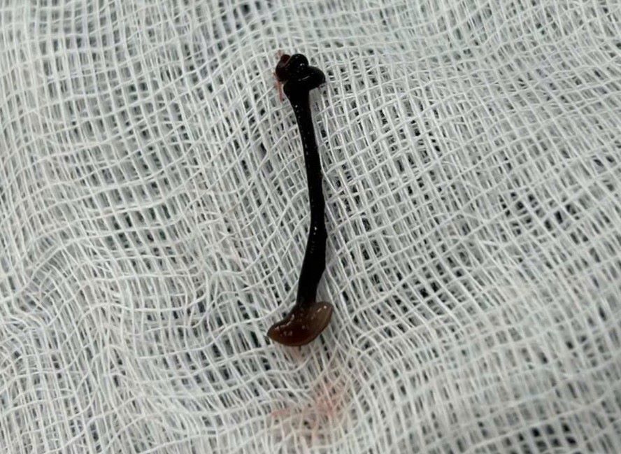 3cm 길이의 뱀이 꽝응아이 어린이의 코에 1주일 동안 살다가 발견되었습니다. 사진: 김니