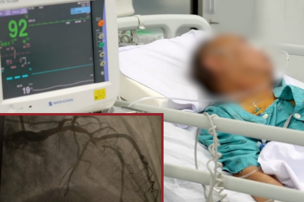 Myocardial infarction increases in young people, a silent sign, serious consequences