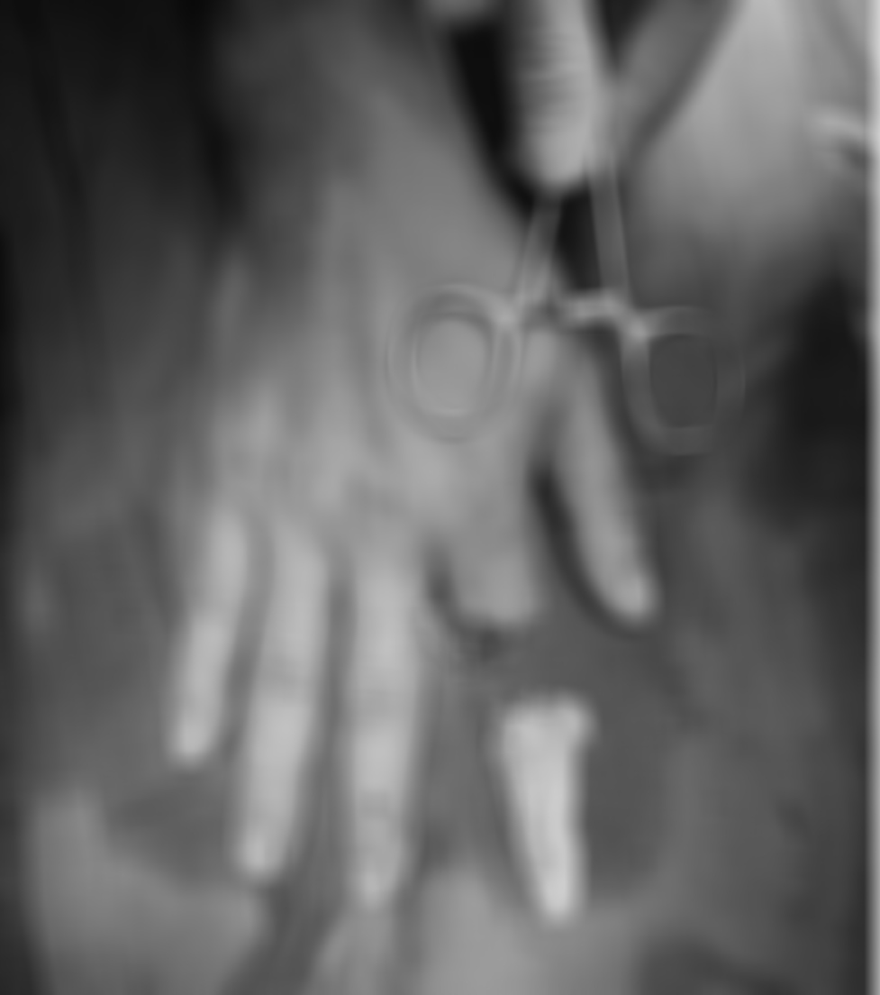 Hinh anh ngon tay tro dut roi cua benh nhan truoc phau thuat vi phau noi ngon tay. Anh: BVCC