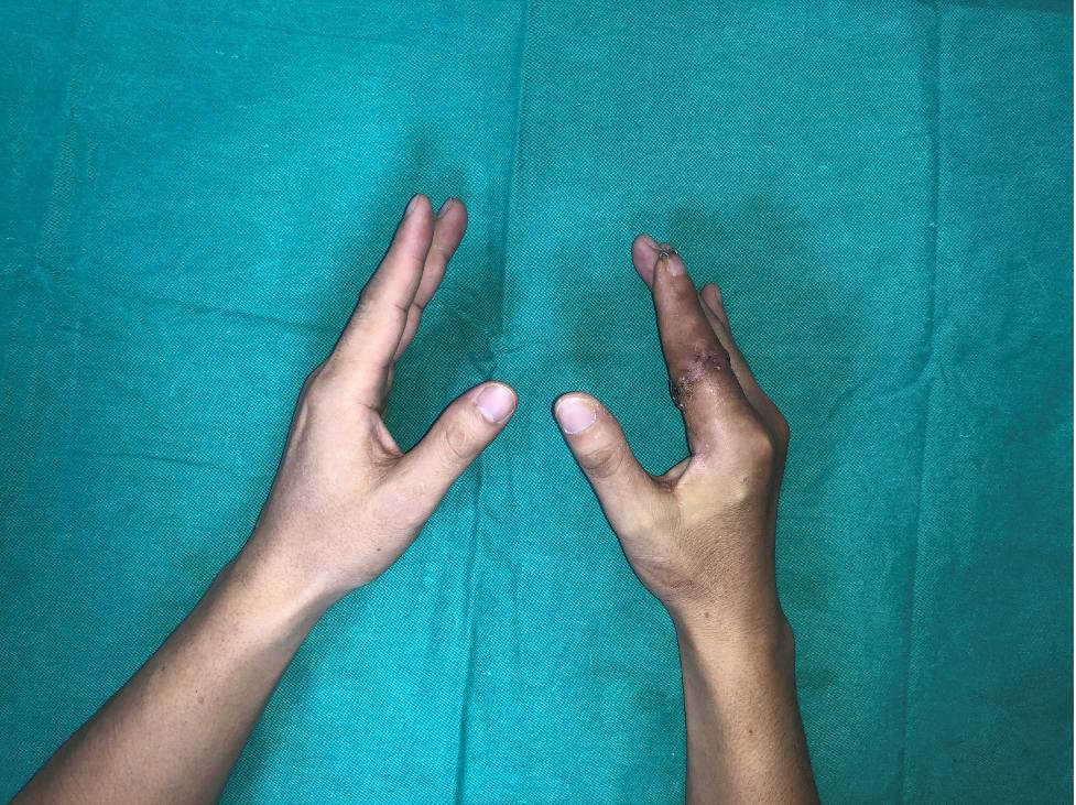 Ca phau thuat dien ra thanh cong voi ngon tay duoc noi lien sau 25 gio. Anh: BVCC