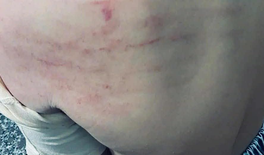 La familia descubrio muchos moretones y rasguños en el cuerpo del estudiante de tercer grado despues de regresar de la escuela. Foto: Proporcionada por el familiar