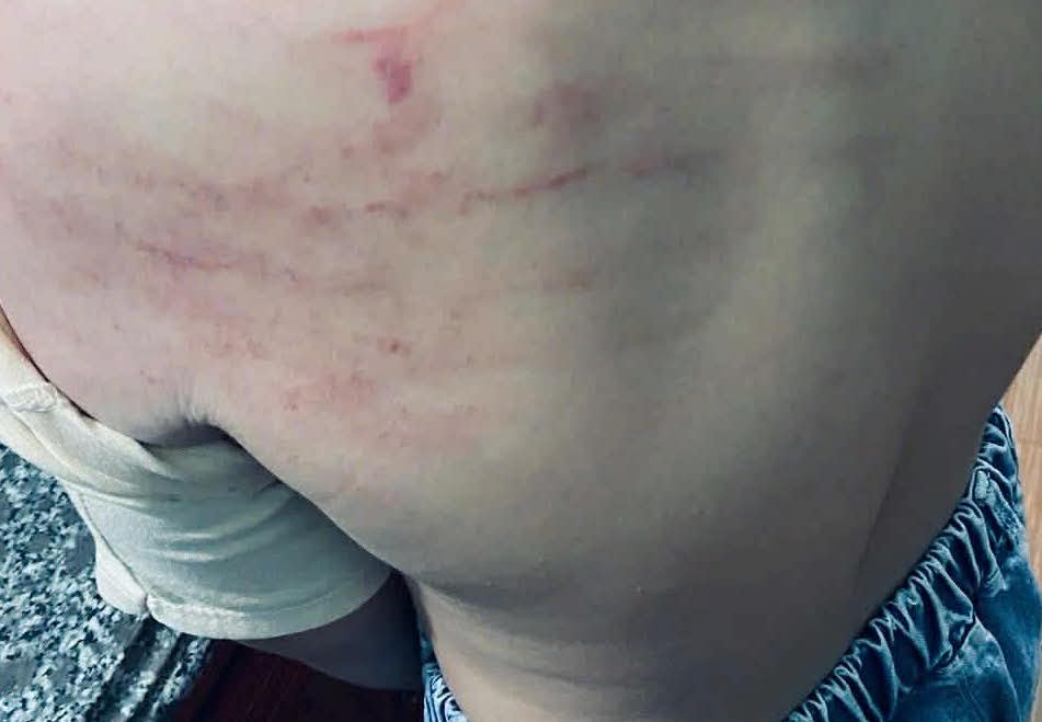 Vet bam tim tren vai, lung hoc sinh theo phan anh cua gia dinh.