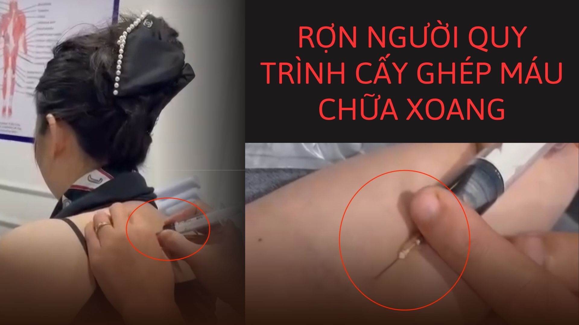 The terrifying image of the "blood transplant" process to treat Tubers in Hue. Photo: PV