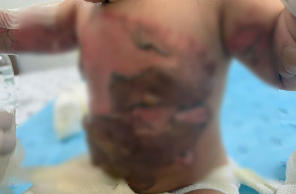 Child severely burned after reaching out and knocking over a pot of boiling sweet soup. Photo: BVCC