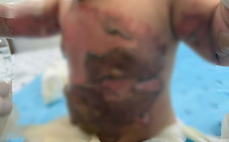 Child severely burned after reaching out and knocking over a pot of boiling sweet soup. Photo: BVCC