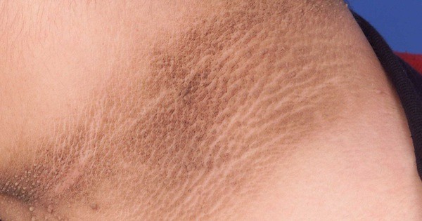 Black spines and excess skin watch out for diabetes. Artwork: Bach Mai Hospital