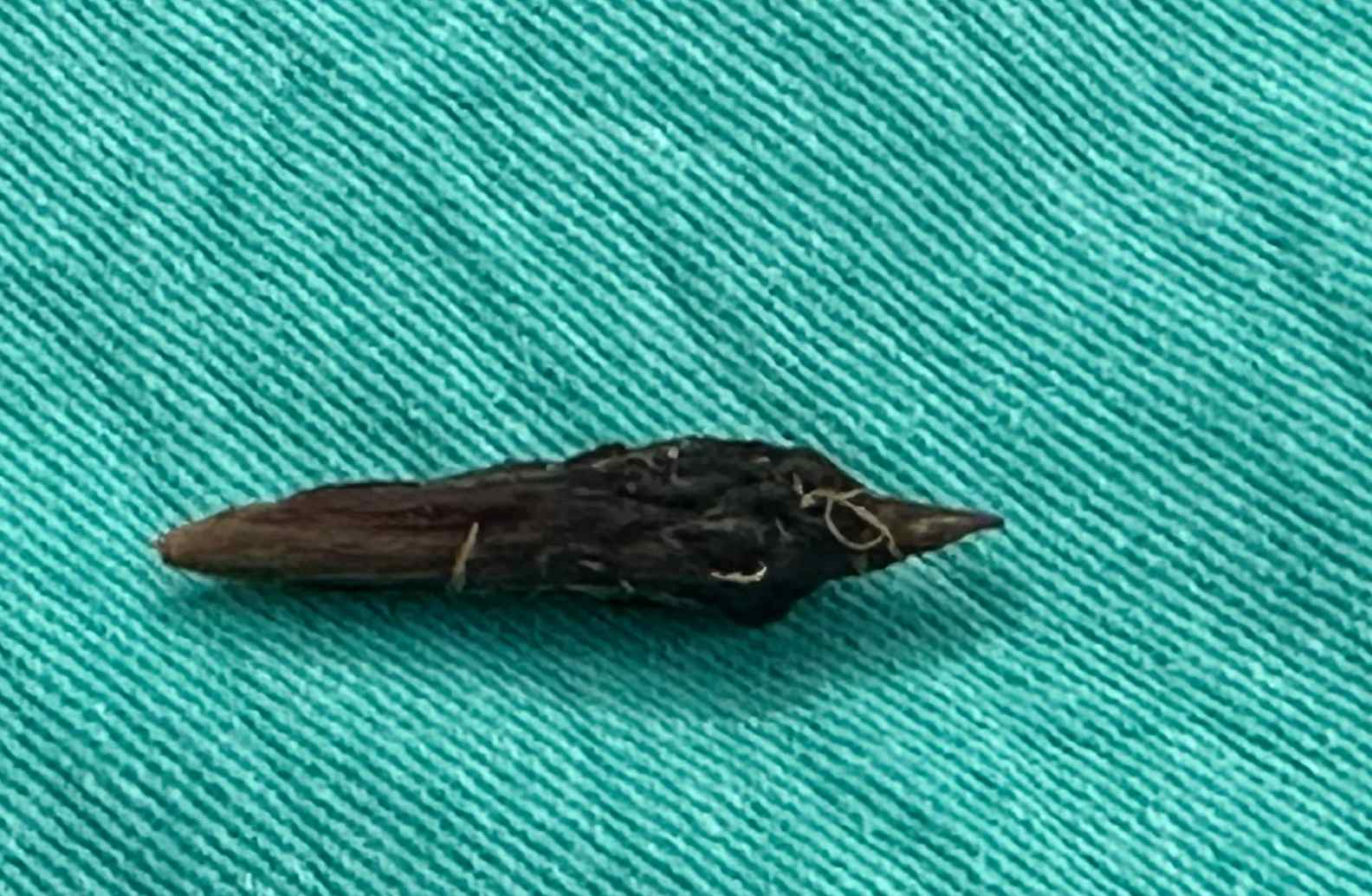 Hạt táo đỏ gây thủng ruột người bệnh được lấy ra. Ảnh: BVCC